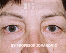 Eyelid Ptosis Repair Before Photo by Milan Jovanovic, MD, PhD; Belgrade,  - Case 37824