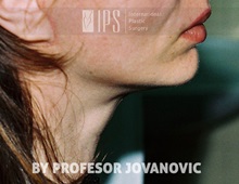 Facelift After Photo by Milan Jovanovic, MD, PhD; Belgrade,  - Case 37825