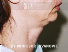 Facelift Before Photo by Milan Jovanovic, MD, PhD; Belgrade,  - Case 37825