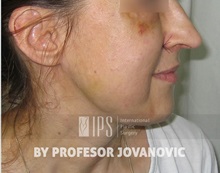 Facial Implants After Photo by Milan Jovanovic, MD, PhD; Belgrade,  - Case 37826