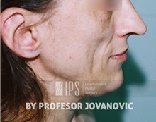 Facial Implants Before Photo by Milan Jovanovic, MD, PhD; Belgrade,  - Case 37826