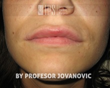 Lip Augmentation/Enhancement After Photo by Milan Jovanovic, MD, PhD; Belgrade,  - Case 37827