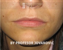 Lip Augmentation/Enhancement Before Photo by Milan Jovanovic, MD, PhD; Belgrade,  - Case 37827