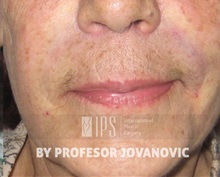 Dermal Fillers After Photo by Milan Jovanovic, MD, PhD; Belgrade,  - Case 37828