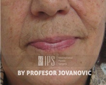 Dermal Fillers Before Photo by Milan Jovanovic, MD, PhD; Belgrade,  - Case 37828