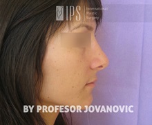 Rhinoplasty After Photo by Milan Jovanovic, MD, PhD; Belgrade,  - Case 37829