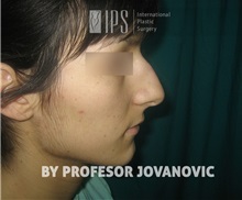 Rhinoplasty Before Photo by Milan Jovanovic, MD, PhD; Belgrade,  - Case 37829