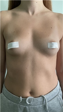 Breast Augmentation Before Photo by Massimo Tempesta, MD; Rome, RM - Case 48001