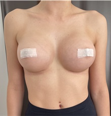Breast Augmentation After Photo by Massimo Tempesta, MD; Rome, RM - Case 48039