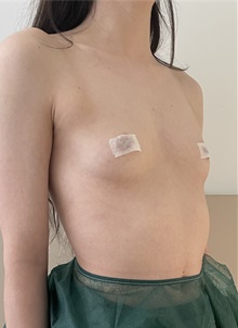 Breast Augmentation Before Photo by Massimo Tempesta, MD; Rome, RM - Case 48039