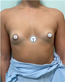 Breast Augmentation Before Photo by Massimo Tempesta, MD; Rome, RM - Case 48174