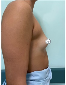 Breast Augmentation Before Photo by Massimo Tempesta, MD; Rome, RM - Case 48174