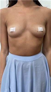Breast Augmentation Before Photo by Massimo Tempesta, MD; Rome, RM - Case 48435