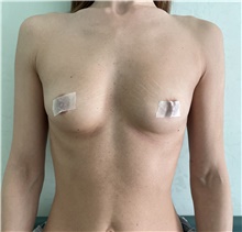 Breast Augmentation Before Photo by Massimo Tempesta, MD; Rome, RM - Case 49004