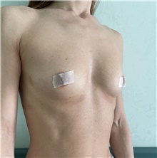 Breast Augmentation Before Photo by Massimo Tempesta, MD; Rome, RM - Case 49004