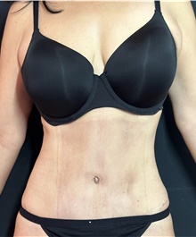 Tummy Tuck After Photo by Ryan Neinstein, MD; New York, NY - Case 46691