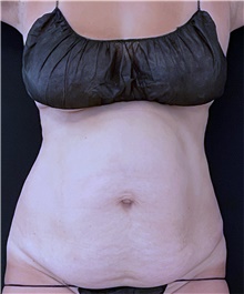 Tummy Tuck Before Photo by Ryan Neinstein, MD; New York, NY - Case 46691
