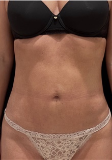 Before & After: Thigh Liposuction - Neinstein Plastic Surgery