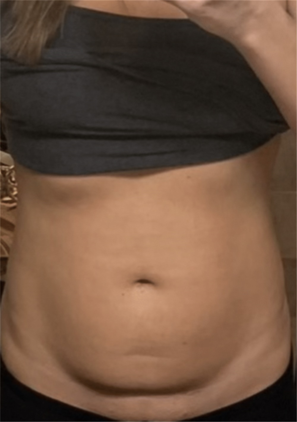 Tummy Tuck Before and After Photos by Ryan Neinstein, MD; New York, NY -  Case 46692