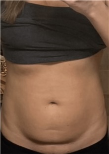 Tummy Tuck Before Photo by Ryan Neinstein, MD; New York, NY - Case 46692