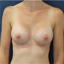 Breast Augmentation After Photo by Reza Nassab, MBChB MSc MBA FRCS(Plast); Manchester, ENG - Case 47923