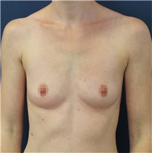 Breast Augmentation Before Photo by Reza Nassab, MBChB MSc MBA FRCS(Plast); Manchester, ENG - Case 47923