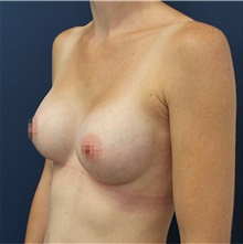 Breast Augmentation After Photo by Reza Nassab, MBChB MSc MBA FRCS(Plast); Manchester, ENG - Case 47923