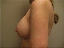 Breast Augmentation After Photo by Nicholas Leonardi, DO; Germantown, TN - Case 42427