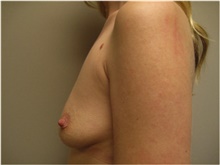 Breast Augmentation Before Photo by Nicholas Leonardi, DO; Germantown, TN - Case 42427