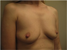Breast Augmentation Before Photo by Nicholas Leonardi, DO; Germantown, TN - Case 42427