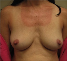 Breast Augmentation Before Photo by Nicholas Leonardi, DO; Germantown, TN - Case 42428