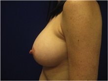 Breast Augmentation After Photo by Nicholas Leonardi, DO; Germantown, TN - Case 42428