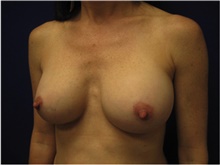 Breast Augmentation After Photo by Nicholas Leonardi, DO; Germantown, TN - Case 42428