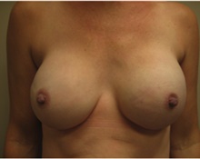 Breast Reconstruction After Photo by Nicholas Leonardi, DO; Germantown, TN - Case 42432