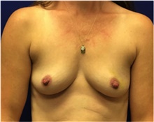 Breast Reconstruction Before Photo by Nicholas Leonardi, DO; Memphis, TN - Case 42432