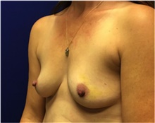 Breast Reconstruction Before Photo by Nicholas Leonardi, DO; Germantown, TN - Case 42432