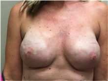 Breast Reconstruction After Photo by Nicholas Leonardi, DO; Germantown, TN - Case 42433
