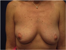 Breast Reconstruction Before Photo by Nicholas Leonardi, DO; Germantown, TN - Case 42433