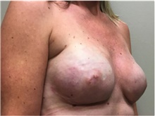 Breast Reconstruction After Photo by Nicholas Leonardi, DO; Germantown, TN - Case 42433
