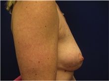Breast Reconstruction Before Photo by Nicholas Leonardi, DO; Germantown, TN - Case 42433
