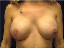 Breast Reconstruction After Photo by Nicholas Leonardi, DO; Germantown, TN - Case 42434