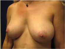 Breast Reconstruction Before Photo by Nicholas Leonardi, DO; Germantown, TN - Case 42434