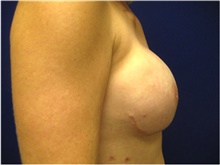 Breast Reconstruction After Photo by Nicholas Leonardi, DO; Germantown, TN - Case 42434
