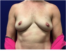 Breast Reconstruction Before Photo by Nicholas Leonardi, DO; Germantown, TN - Case 42435