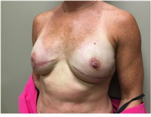 Breast Reconstruction After Photo by Nicholas Leonardi, DO; Germantown, TN - Case 42435