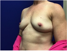 Breast Reconstruction Before Photo by Nicholas Leonardi, DO; Germantown, TN - Case 42435