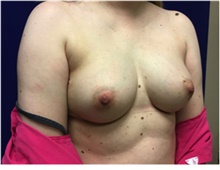Breast Reconstruction Before Photo by Nicholas Leonardi, DO; Germantown, TN - Case 42436