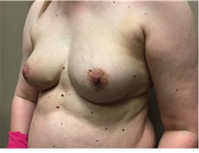 Breast Reconstruction After Photo by Nicholas Leonardi, DO; Germantown, TN - Case 42436