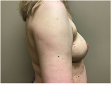 Breast Reconstruction After Photo by Nicholas Leonardi, DO; Germantown, TN - Case 42436