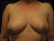 Breast Reconstruction Before Photo by Nicholas Leonardi, DO; Germantown, TN - Case 42437